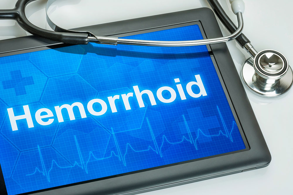 Best ways to manage hemorrhoids